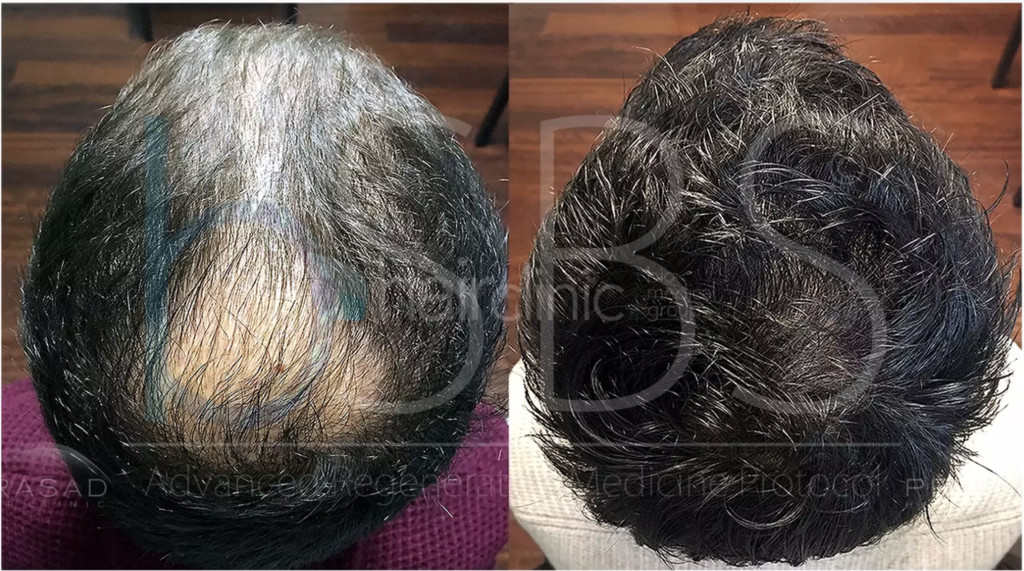 Calvizie Cause E Cura Nell Era Moderna Targatocn It