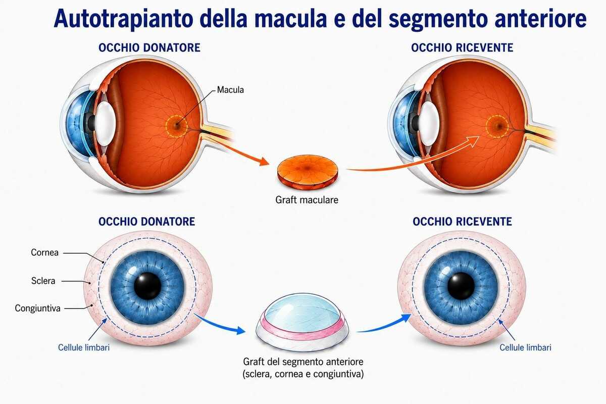 Sala operatoria ospedaliera con strumentazioni chirurgiche oftalmologiche durante intervento delicato, immagine di approfondimento