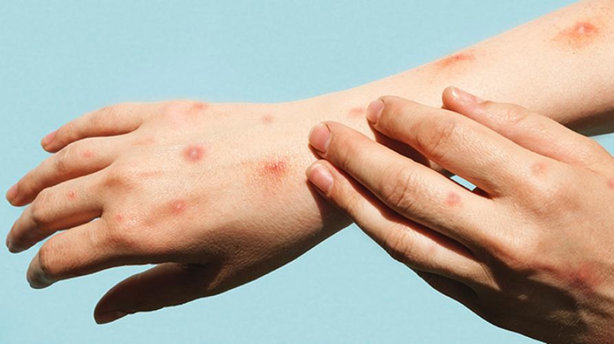 サル痘、ゲイ、トランスジェンダー、バイセクシャルは地域で感染リスクが高い。しかし、それは2022年からの回覧でした – Targatocn.it