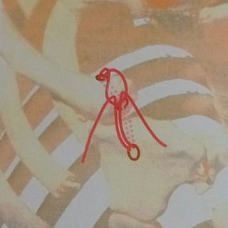 L'intervento è stato reso possibile grazie all'uso di una clavicola in 3D