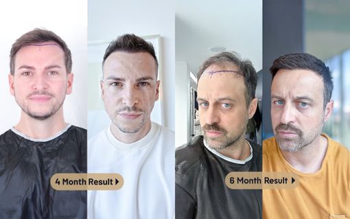 Istanbul Vita: Tecnica Vita e Pianificazione Microscopica