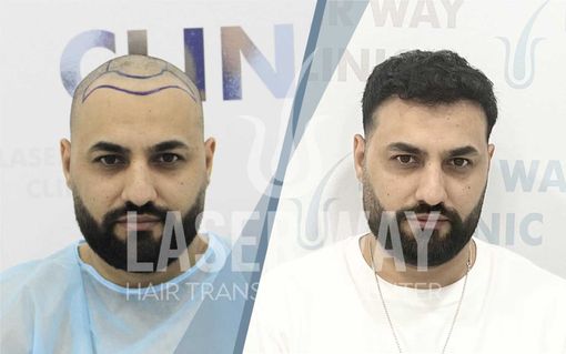 Trapianto di Capelli a Tirana, Albania: Pro e Contro