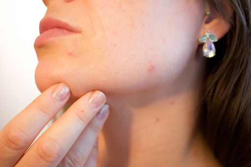 Cura dell'acne Cura dell'acne