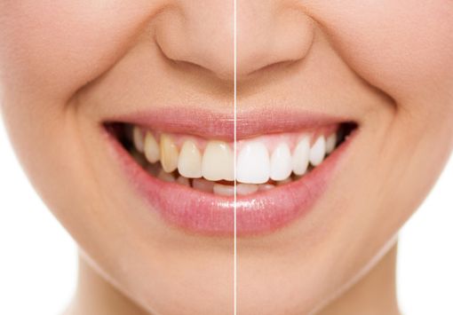 Denti sani e bianchi: i consigli dello Studio Ferri Borgogno di Alba