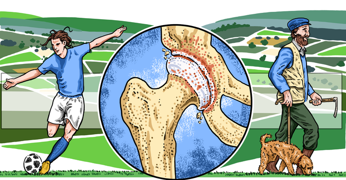 L’Asl Cn2 promuove una campagna gratuita per la prevenzione dell’artrosi all’anca