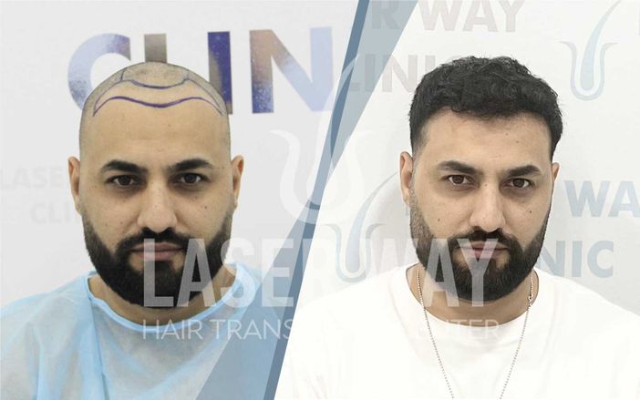 Trapianto di Capelli a Tirana, Albania: Pro e Contro Trapianto di Capelli a Tirana, Albania: Pro e Contro