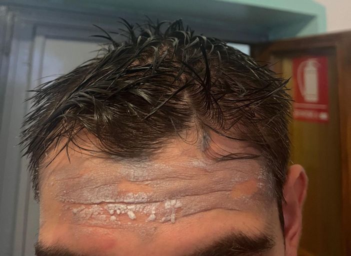 Le ustioni riportate da uno dei due agenti feriti Le ustioni riportate da uno dei due agenti feriti