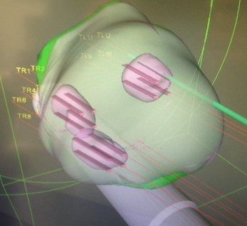 Biopsia prostatica: nuova tecnica presso l’Urologia di Savigliano