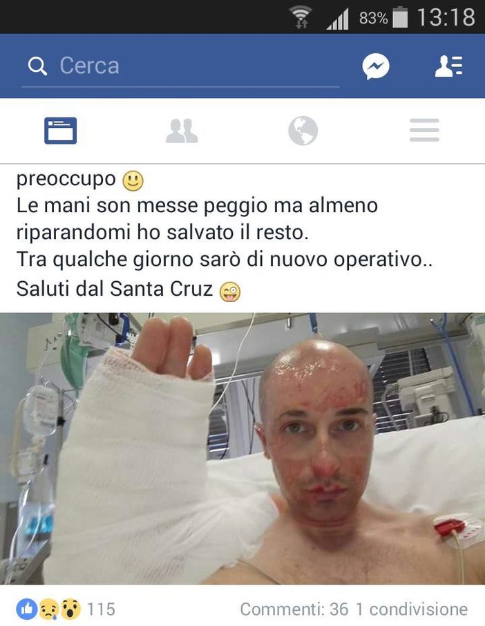 E’ fuori pericolo Franco Picconi, il Consigliere comunale di Limone Piemonte ustionatosi con il fuoco E’ fuori pericolo Franco Picconi, il Consigliere comunale di Limone Piemonte ustionatosi con il fuoco