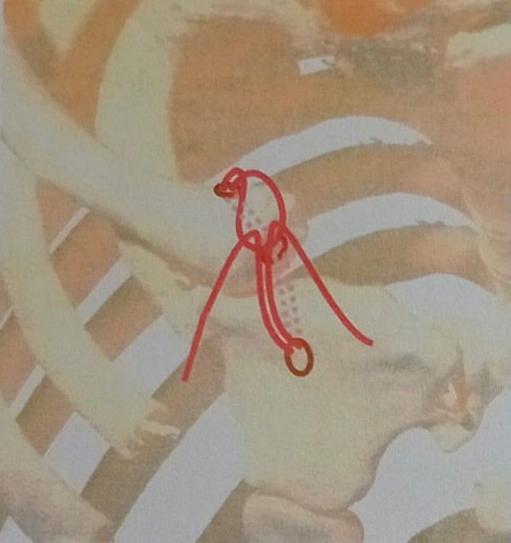 L'intervento è stato reso possibile grazie all'uso di una clavicola in 3D