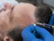 Innovazione tecnologica: la DHI, la migliore tecnica di trapianto capelli