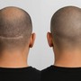 Tricopigmentazione a Torino: quando perdere i capelli cambia anche il modo di vedersi Tricopigmentazione a Torino: quando perdere i capelli cambia anche il modo di vedersi