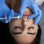 Photoaging e perdita di volumi post-estate: le strategie di medicina estetica per ripristinare il turgore del viso Photoaging e perdita di volumi post-estate: le strategie di medicina estetica per ripristinare il turgore del viso