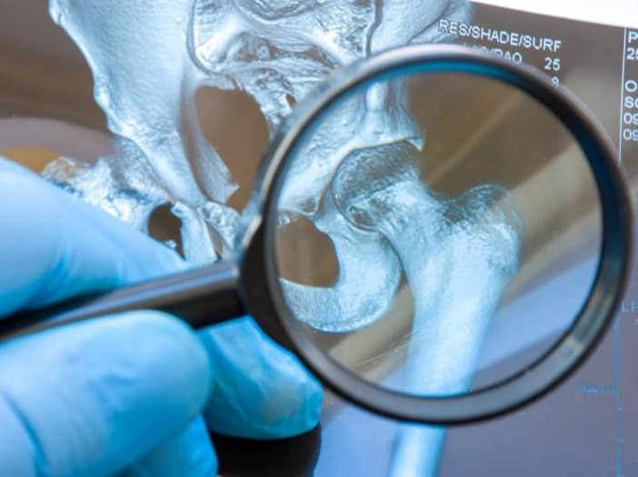 Osteoporosi, check-up gratuito martedì all'ospedale Carle di Cuneo Osteoporosi, check-up gratuito martedì all'ospedale Carle di Cuneo