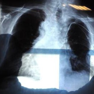 Bpco, pneumologa Foschino Barbaro: "Nella donna sintomi diversi, attenzione alle giovani" Bpco, pneumologa Foschino Barbaro: "Nella donna sintomi diversi, attenzione alle giovani"